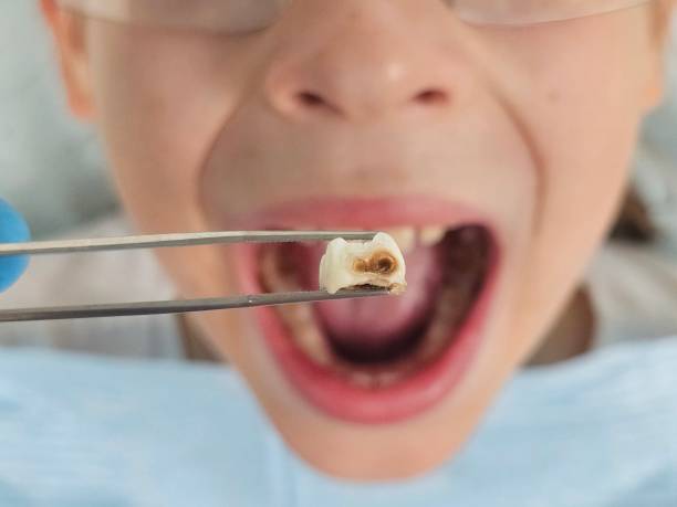 Best Dentist for Tooth Abscess  in Progress Village, FL